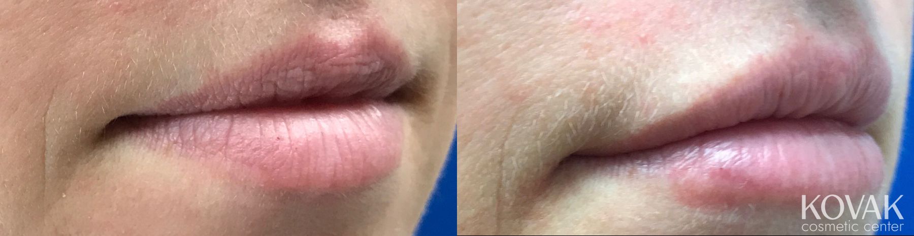 Before and after Lip Augmentation case 36603 - Angle 2