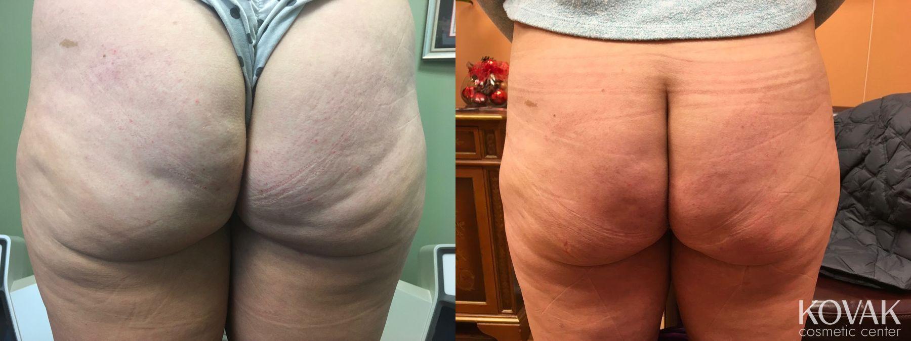 Before and after Cellulite Reduction case 36460