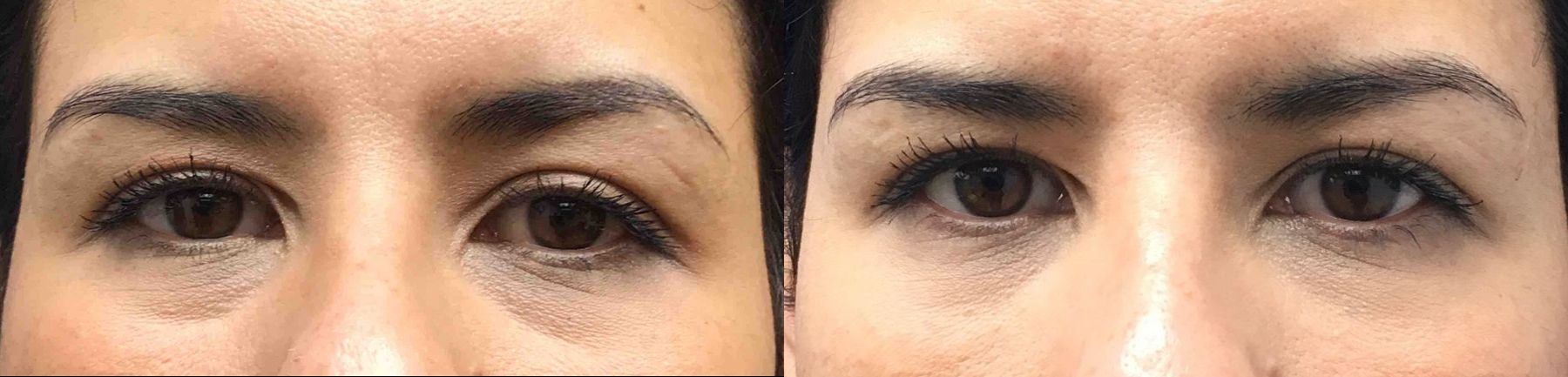 Before and after Restylane® Silk case 36648