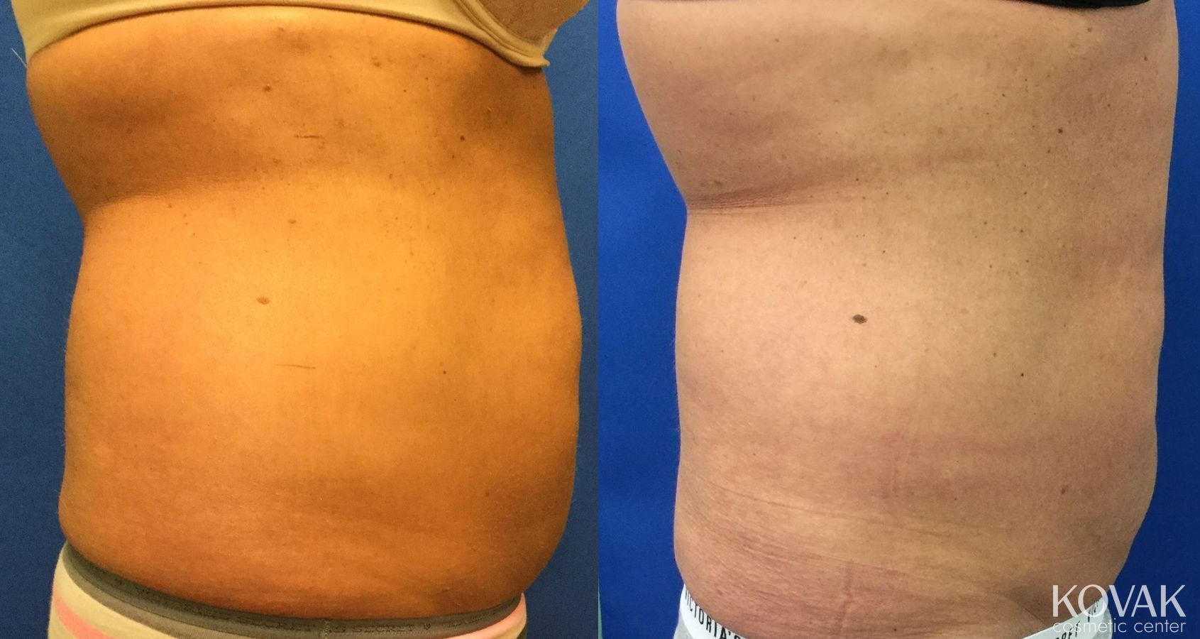 Before and after CoolSculpting® case 36465 - Angle 2