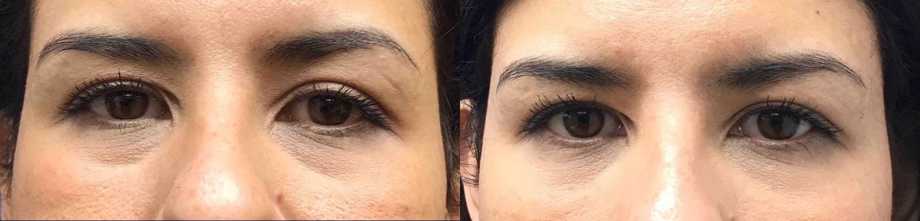 Before and after Injectables - Face case 36647