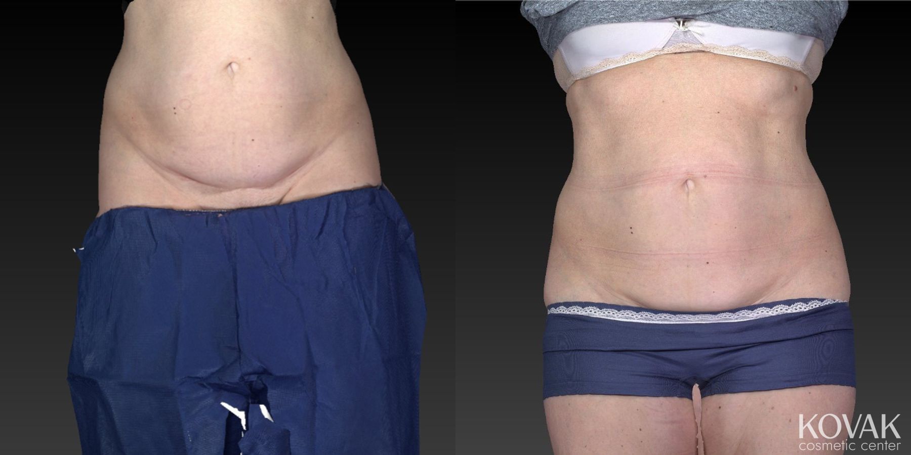 Before and after CoolSculpting® case 36564 - Angle 5
