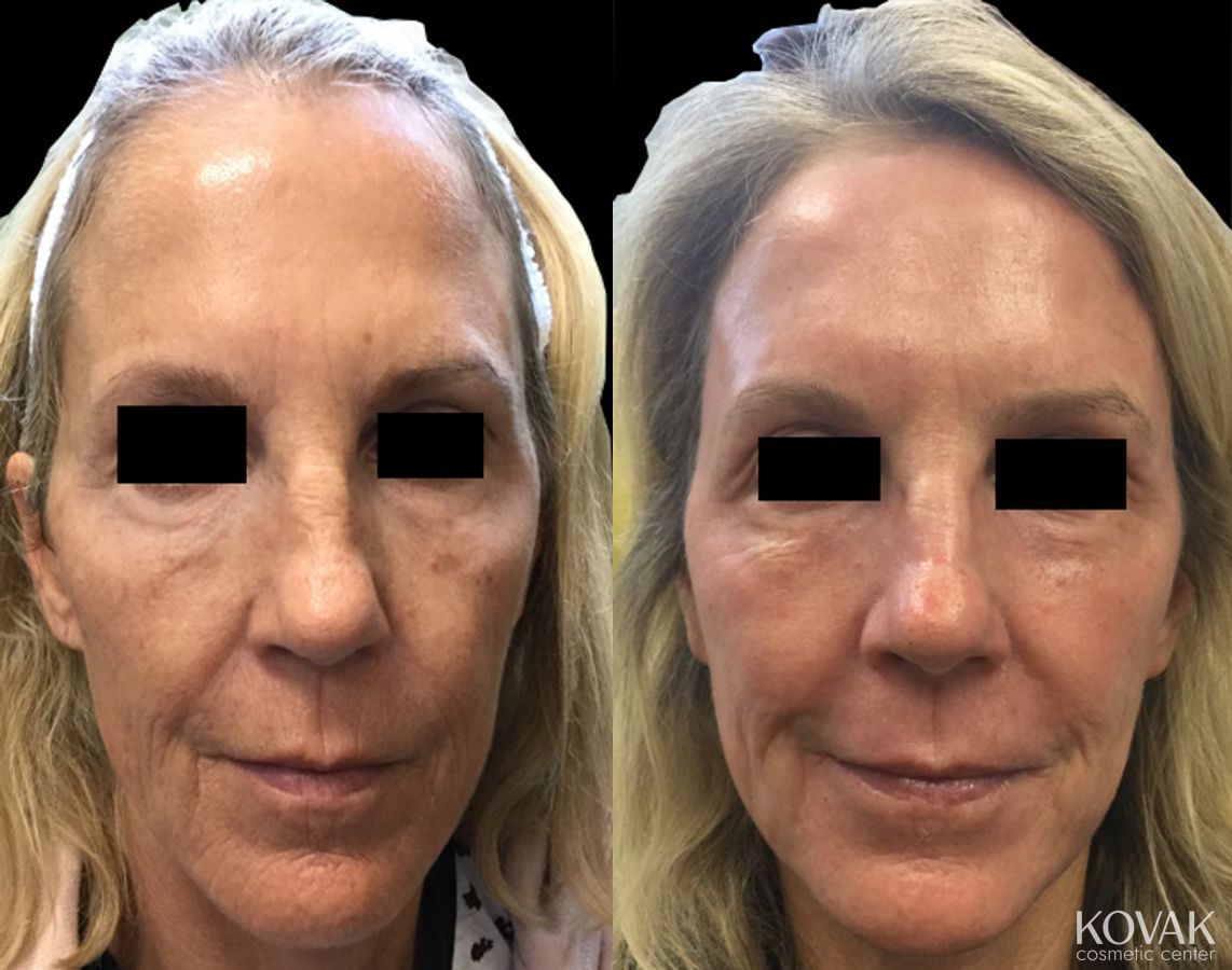 Before and after Laser Skin Resurfacing - Face case 36511