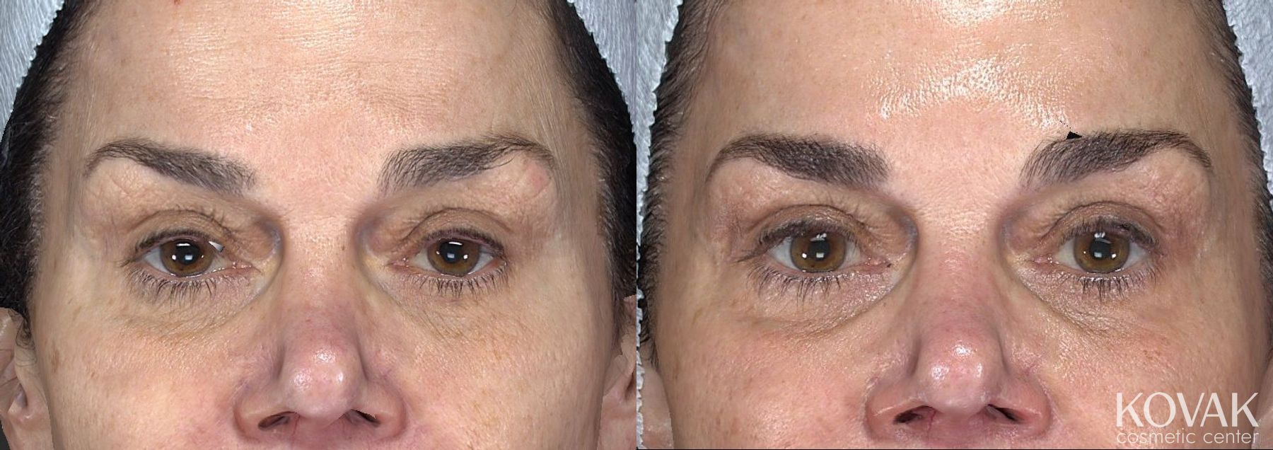 Before and after Laser Skin Resurfacing - Face case 36594 - Angle 4