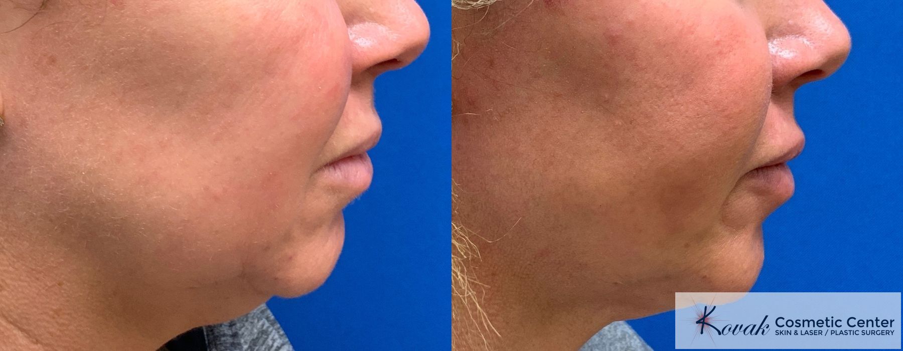 Laser Liposuction - Thumbnail 3