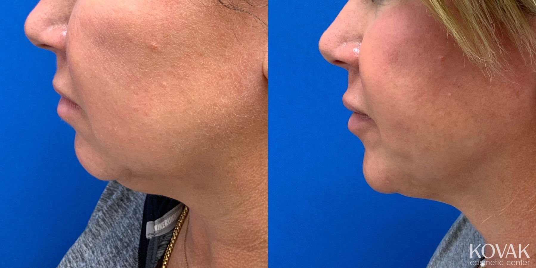 Before and after Laser Liposuction case 36746 - Angle 2