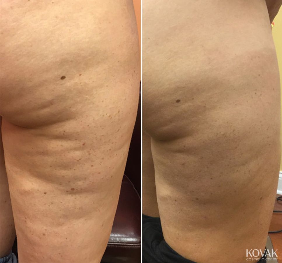 Before and after Cellulite Reduction case 36520 - Angle 3