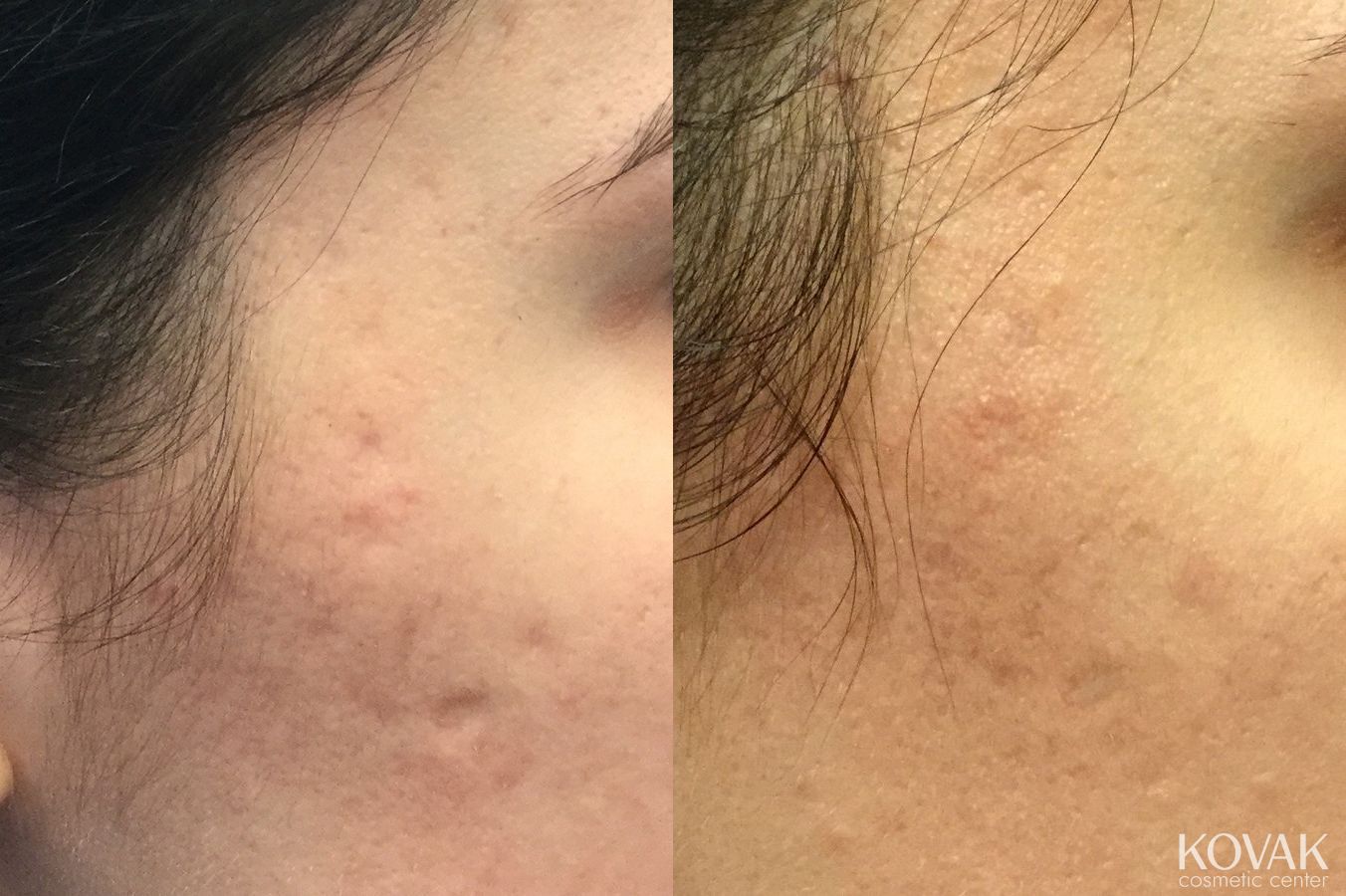 Before and after Acne Scars case 36581