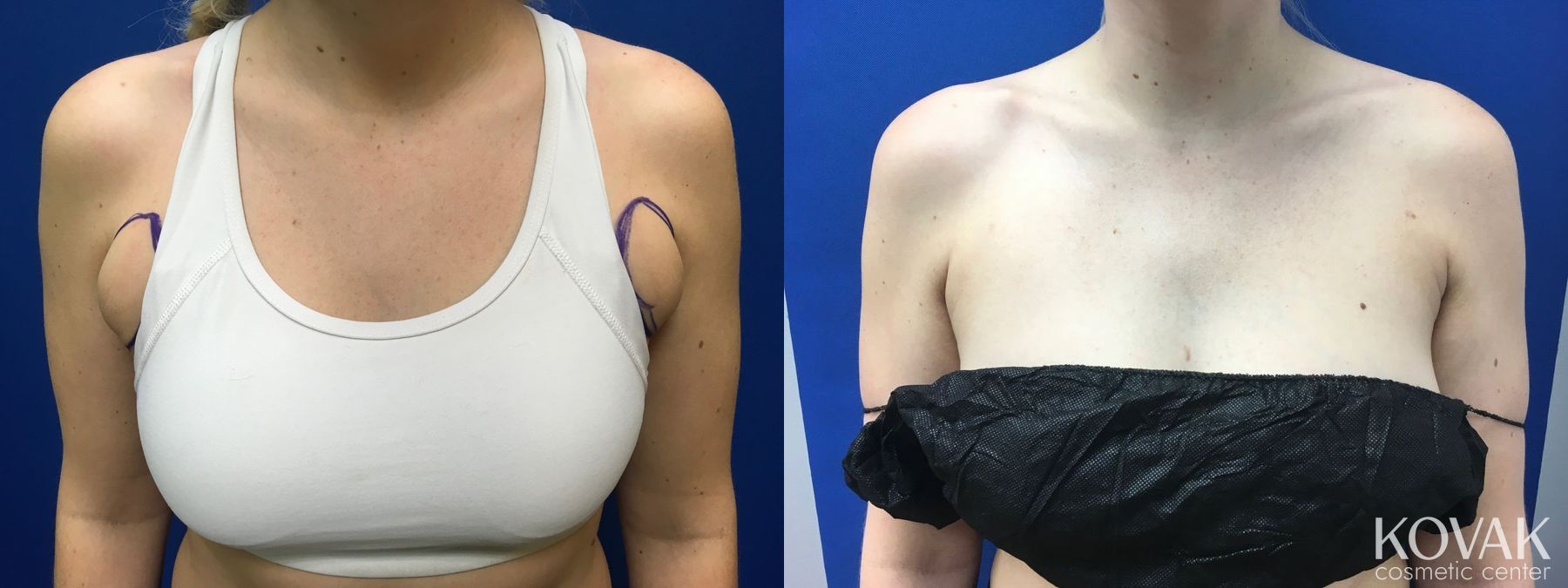 Before and after Laser Liposuction case 36663 - Angle 3