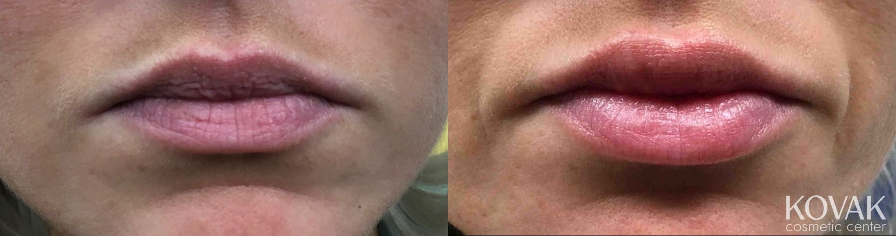 Before and after Juvéderm® XC case 36653