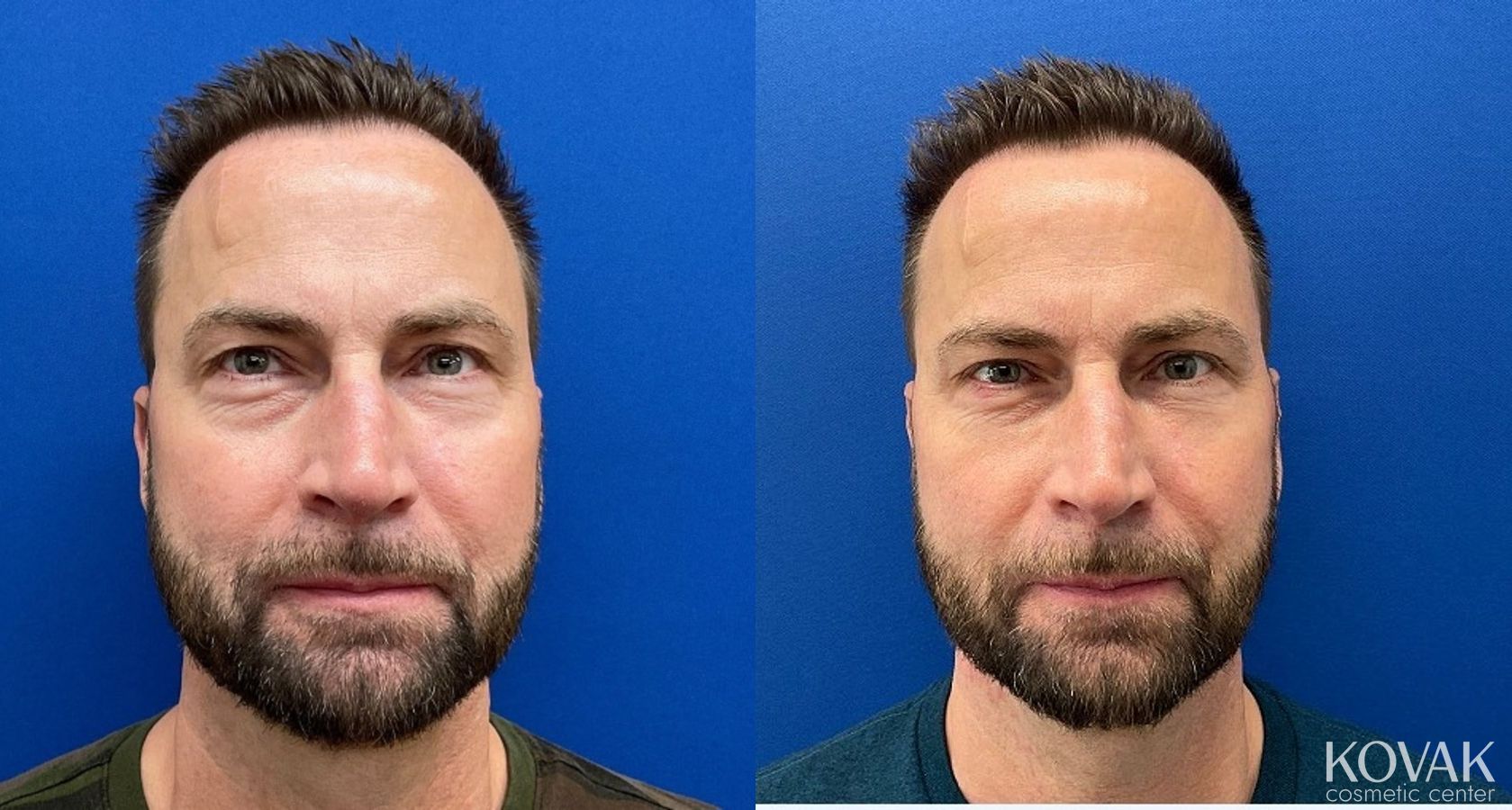 Before and after Fillers case 36772