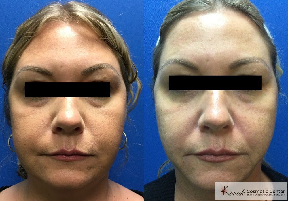 Laser Liposuction - Case 1463