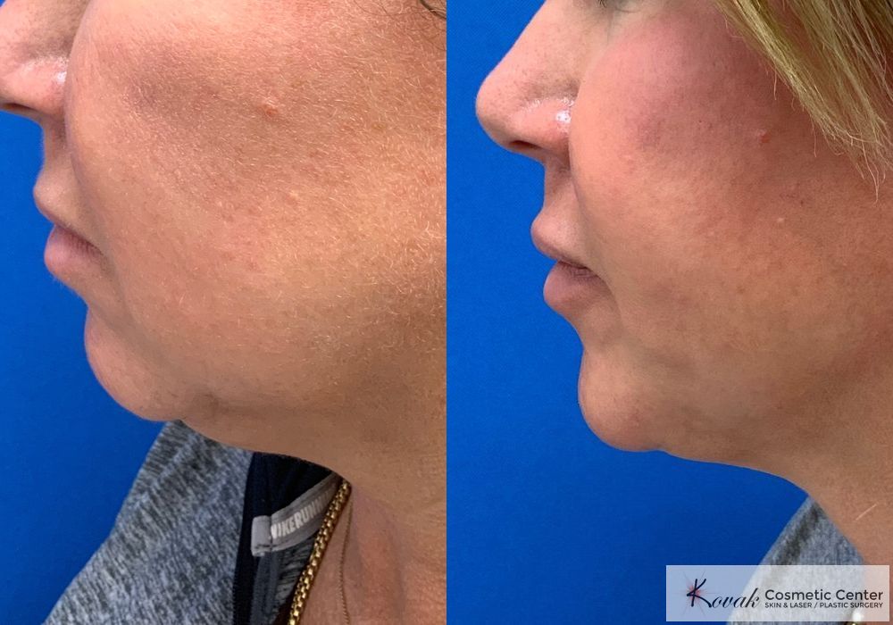 Laser Liposuction - Thumbnail 2