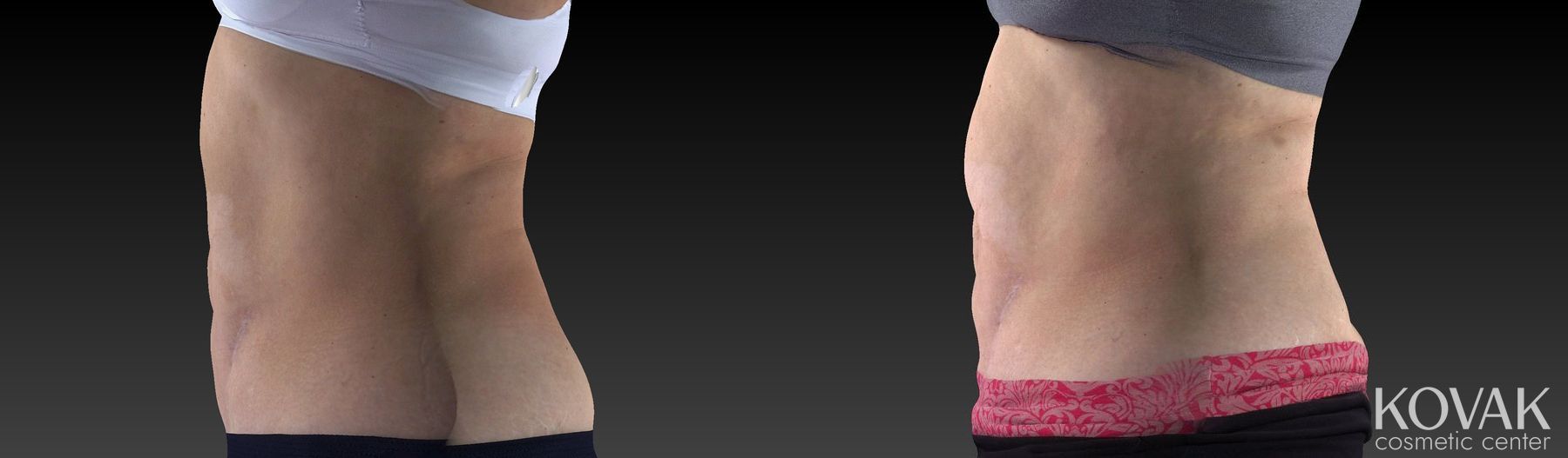 Before and after CoolSculpting® case 36542 - Angle 5