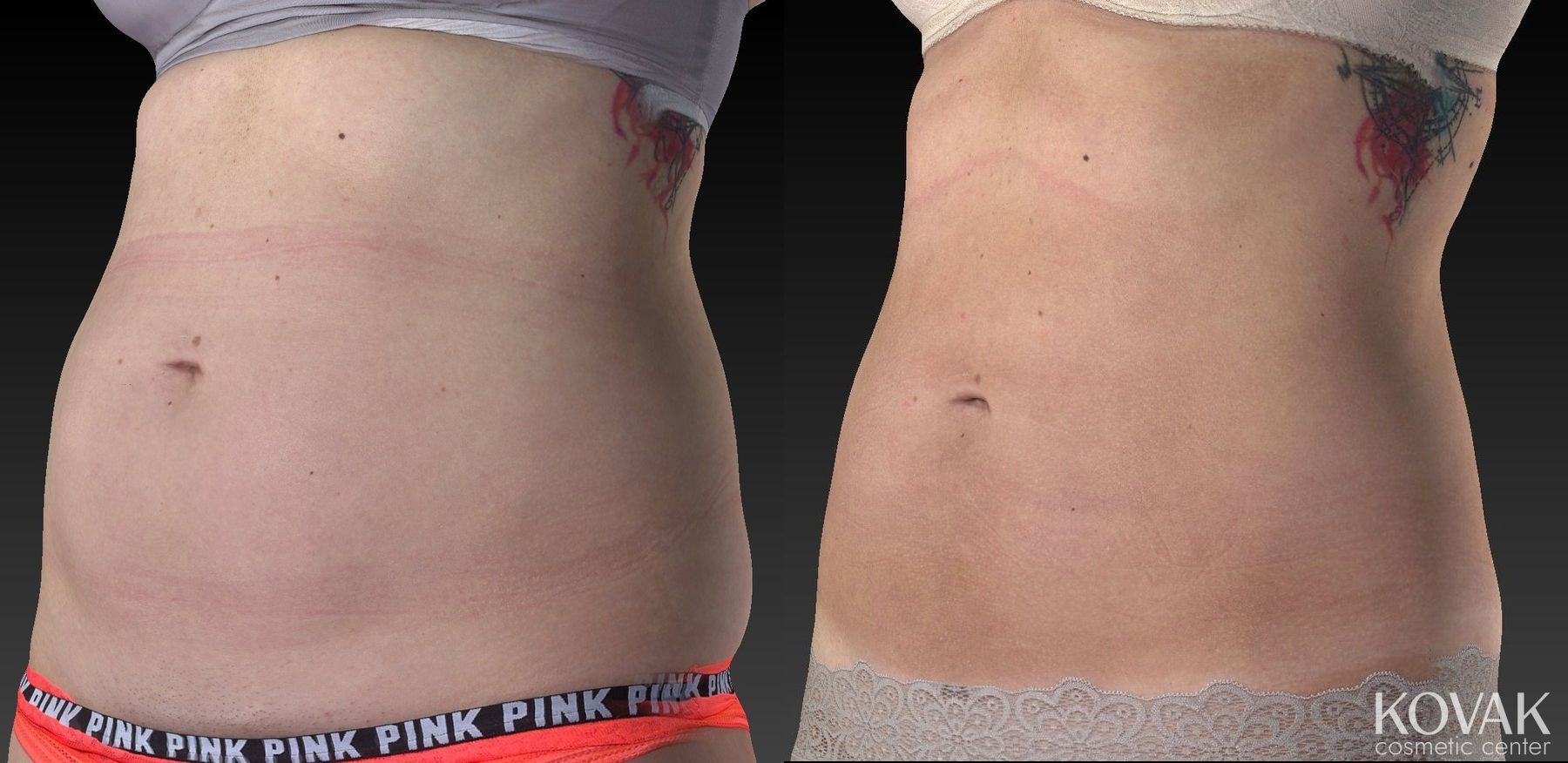 Before and after CoolSculpting® case 36619 - Angle 4