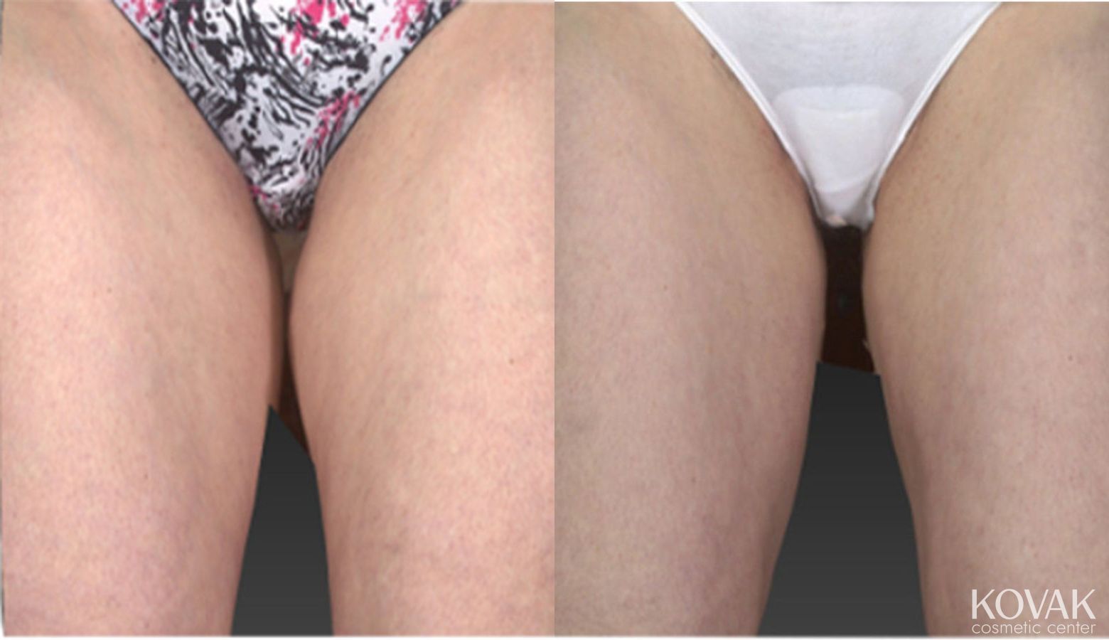 Before and after CoolSculpting® case 36514 - Angle 2