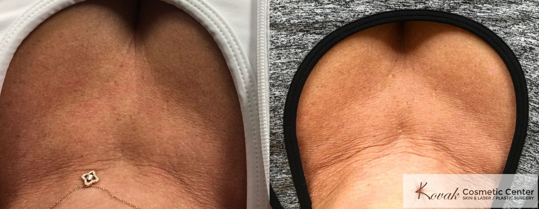 Restylane® Silk - Case 1683