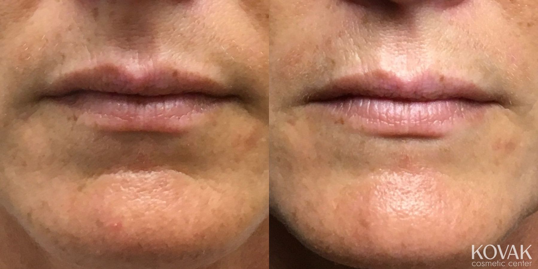 Before and after Fillers case 36660