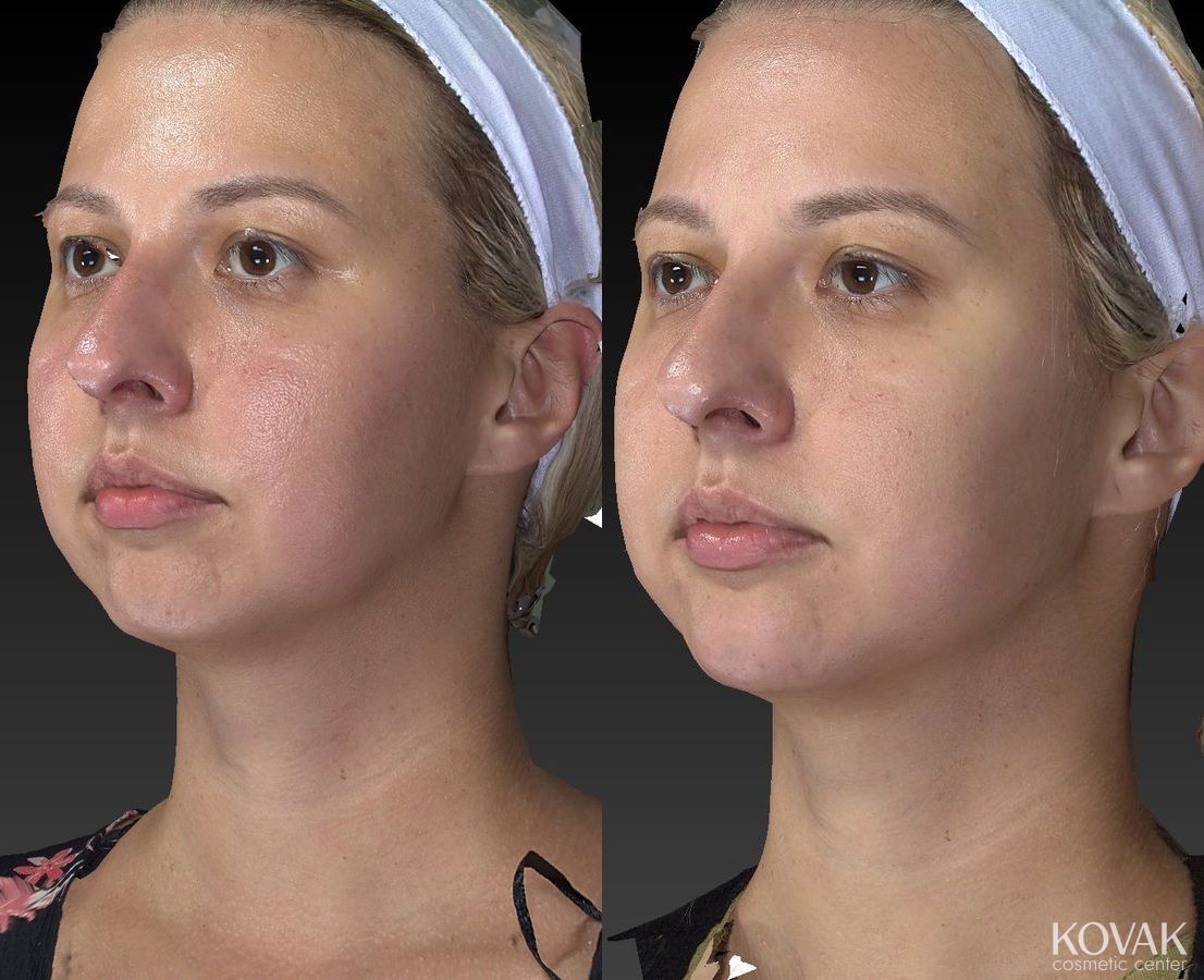 Before and after Restylane® Lyft case 36582 - Angle 3