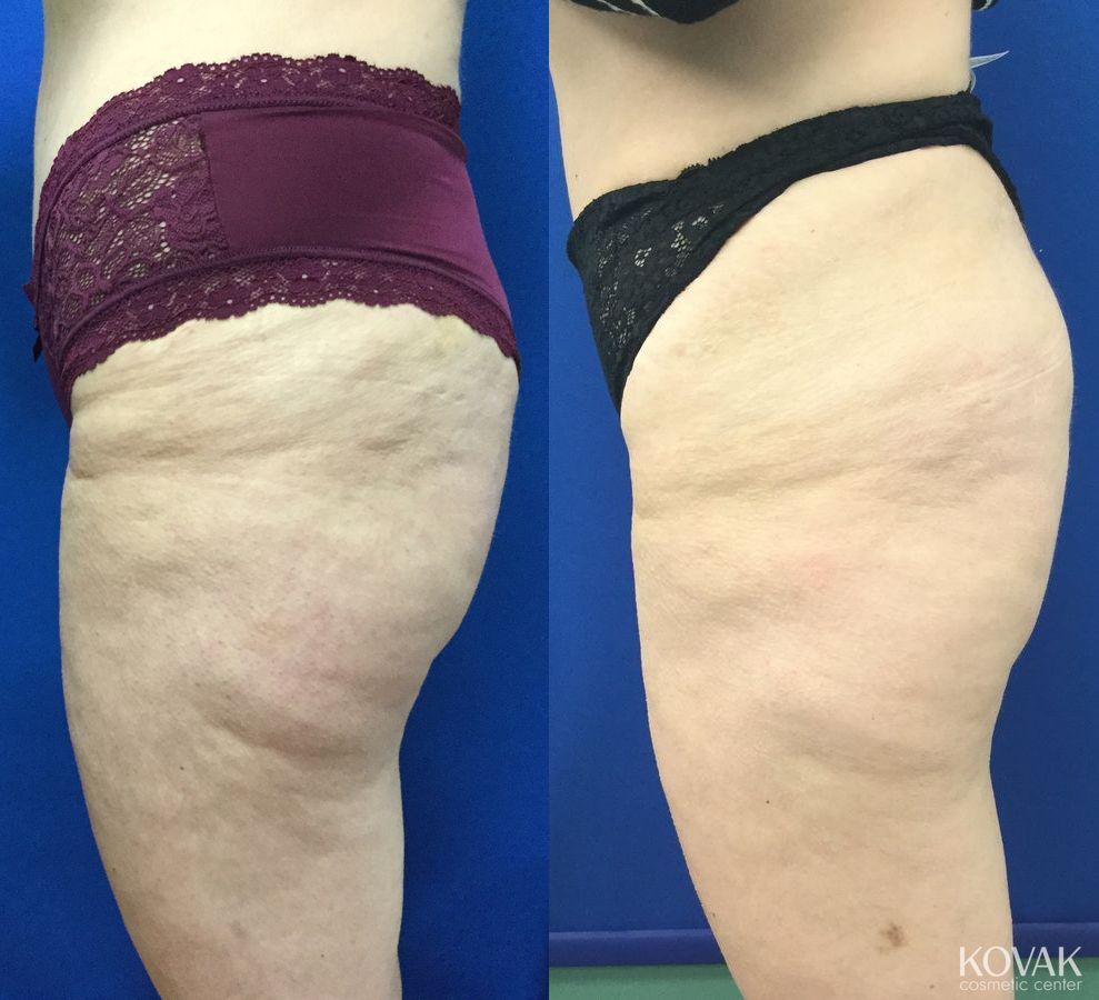 Before and after EMSCULPTĀ® case 36686 - Angle 4