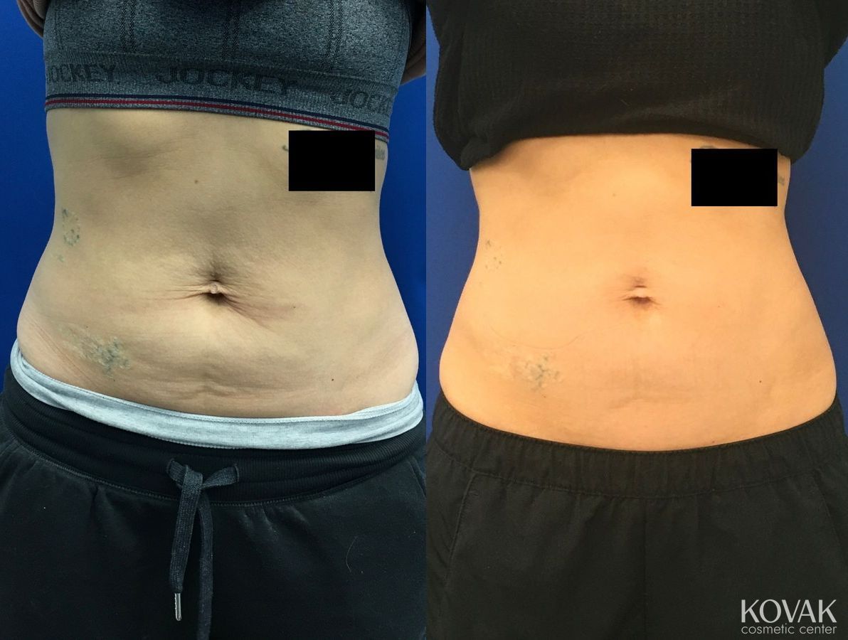 Before and after Emsculpt Neo case 36577