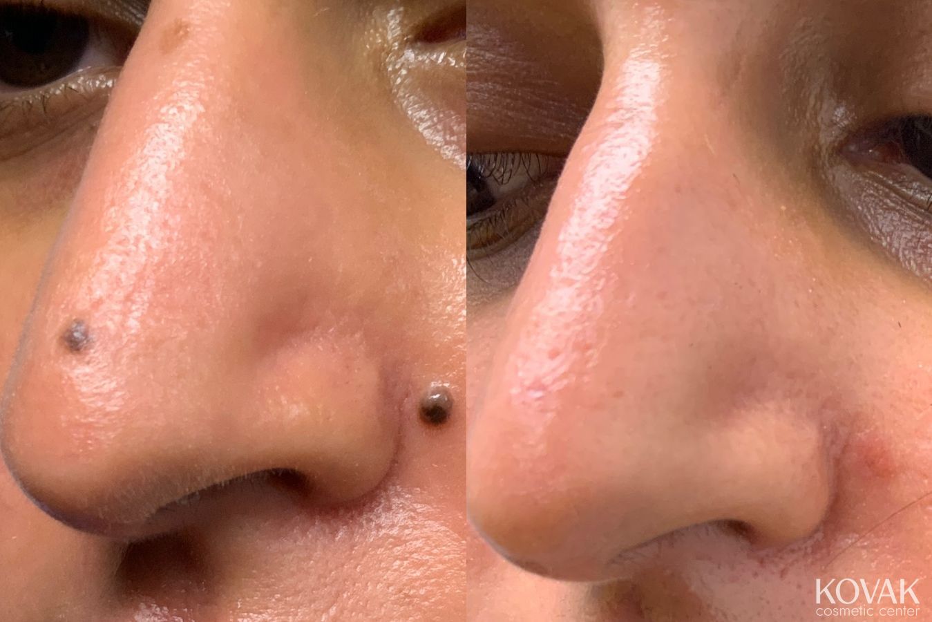 Before and after Mole Removal case 36720