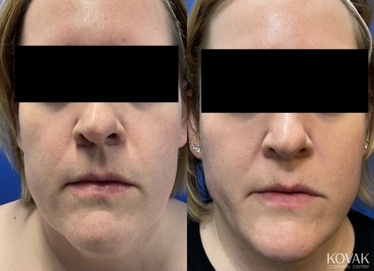 Before and after VLR - Vaser Laser - Jawline Sculpting case 36752