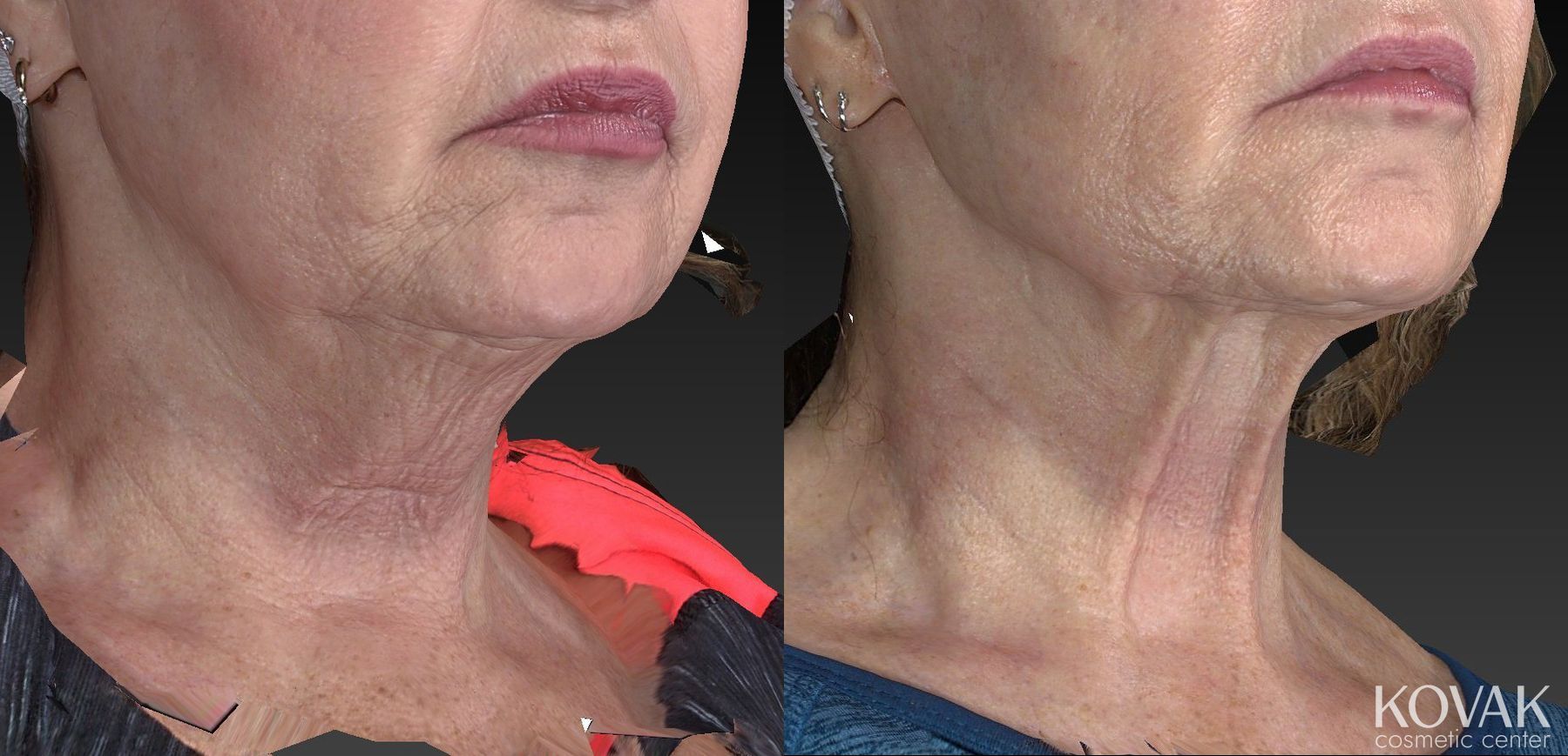 Before and after Kybella case 36483 - Angle 2