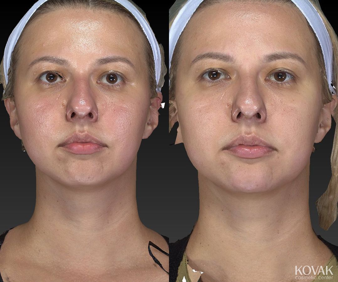 Before and after Restylane® Lyft case 36582 - Angle 4