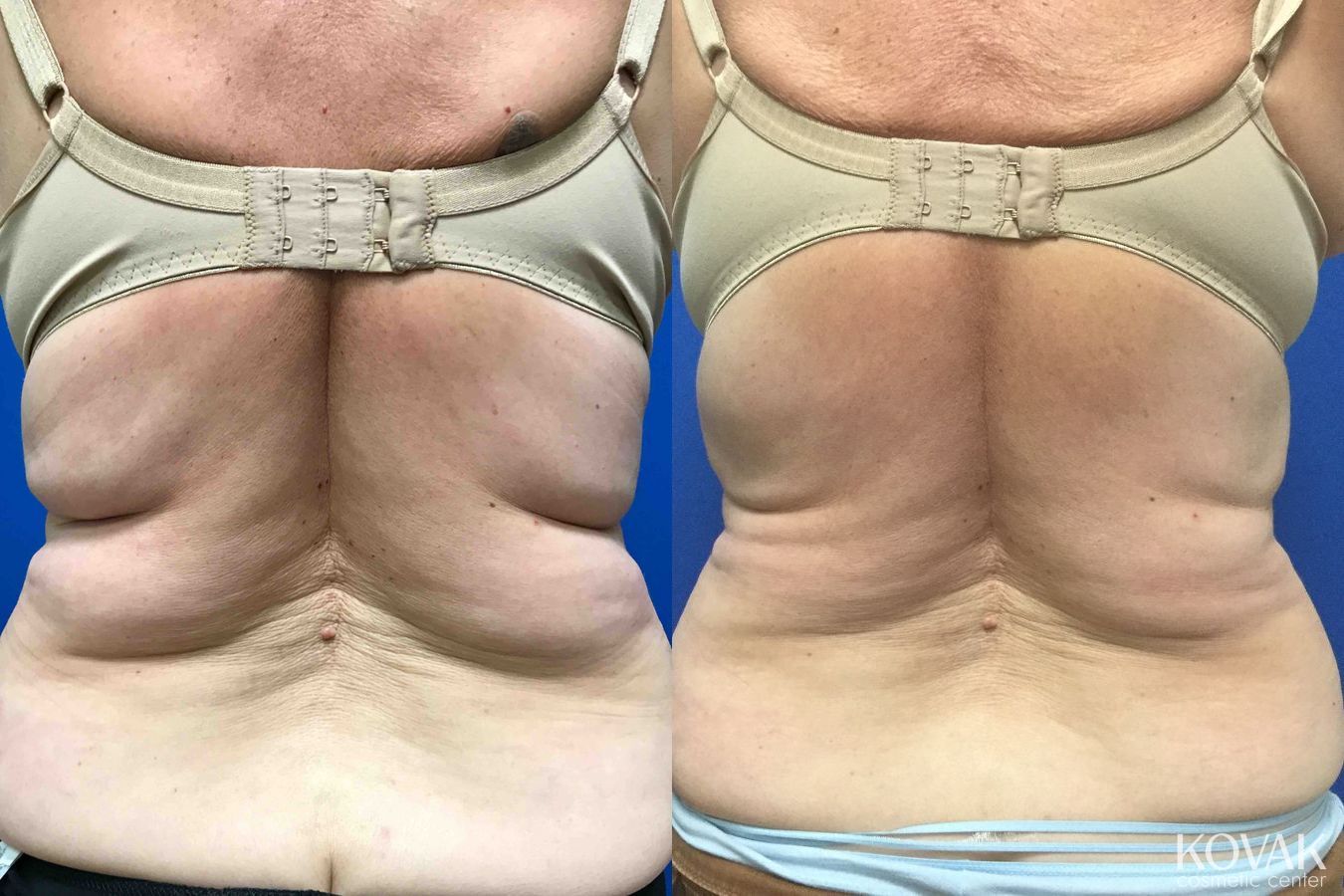 Before and after CoolSculpting® case 36451