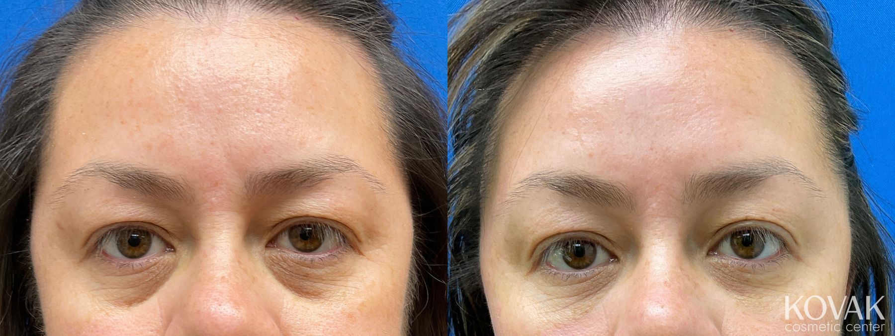 Before and after Eye Treatments case 36719