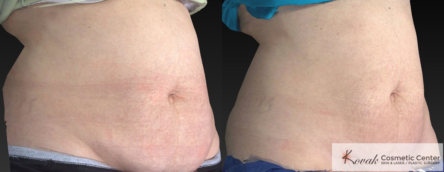 CoolSculpting® - Thumbnail 2