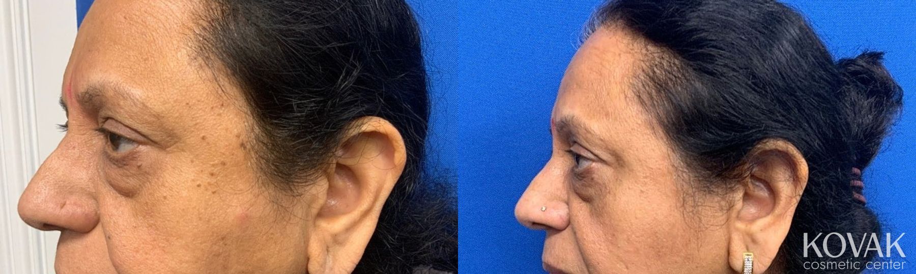 Before and after SEB K case 36777