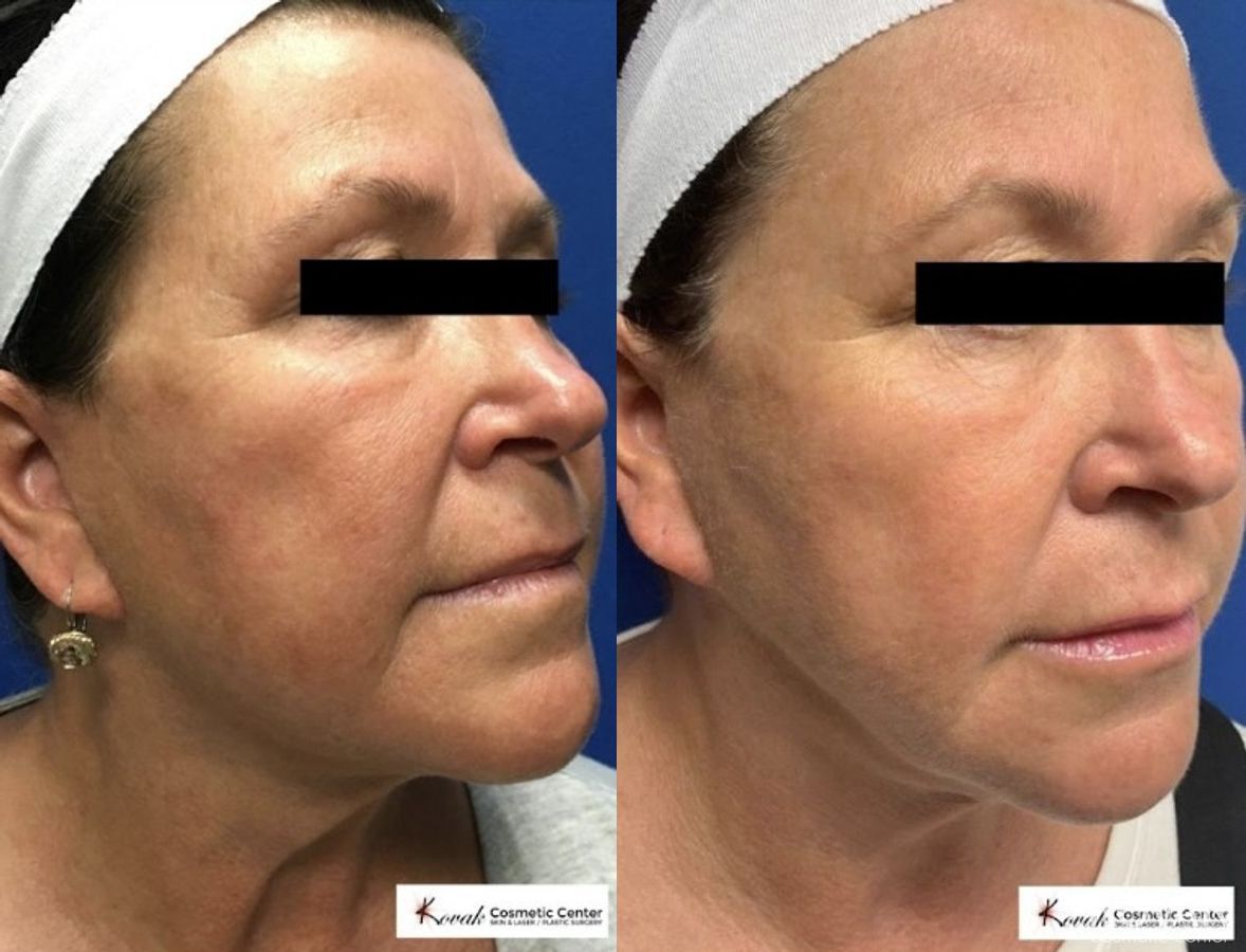 Before and after VLR - Vaser Laser - Jawline Sculpting case 36760