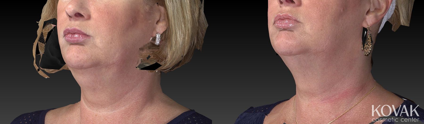 Before and after Kybella case 36478 - Angle 3