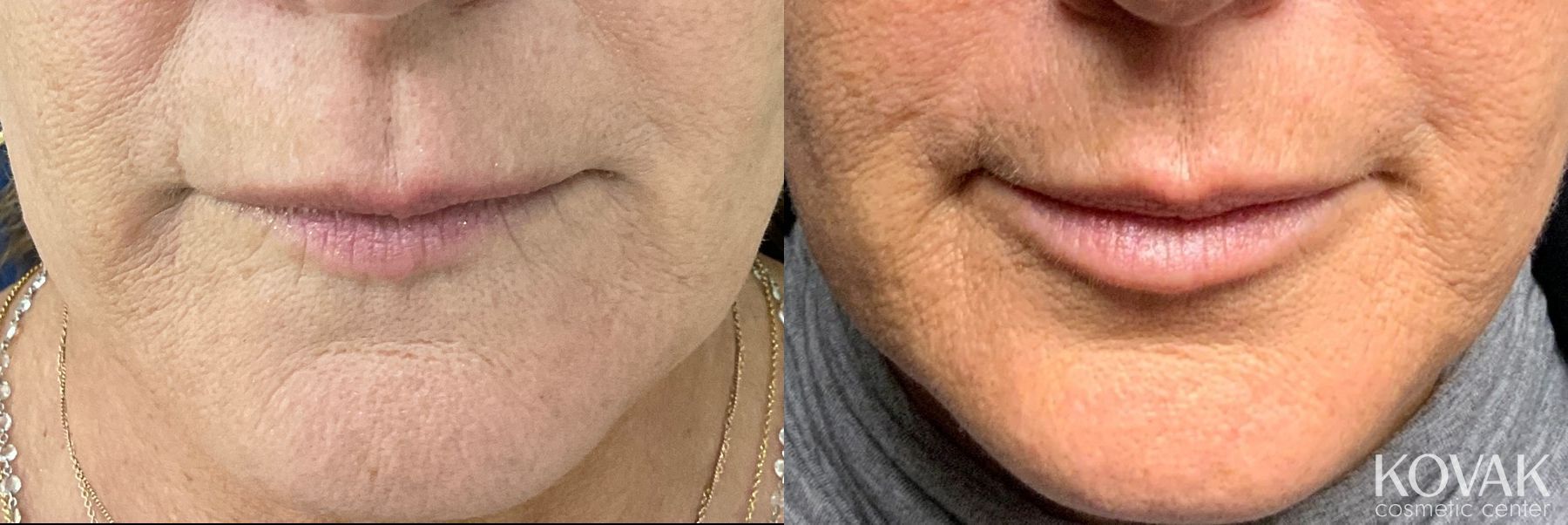 Before and after Lips - Plump / Filled case 36733