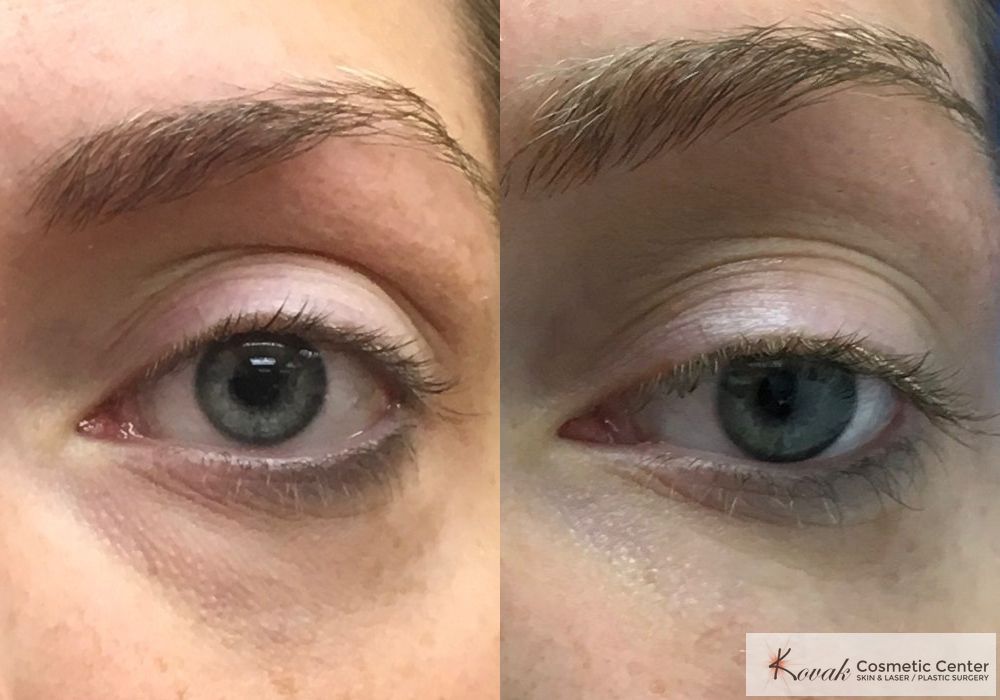 Eye Treatments - Thumbnail 2