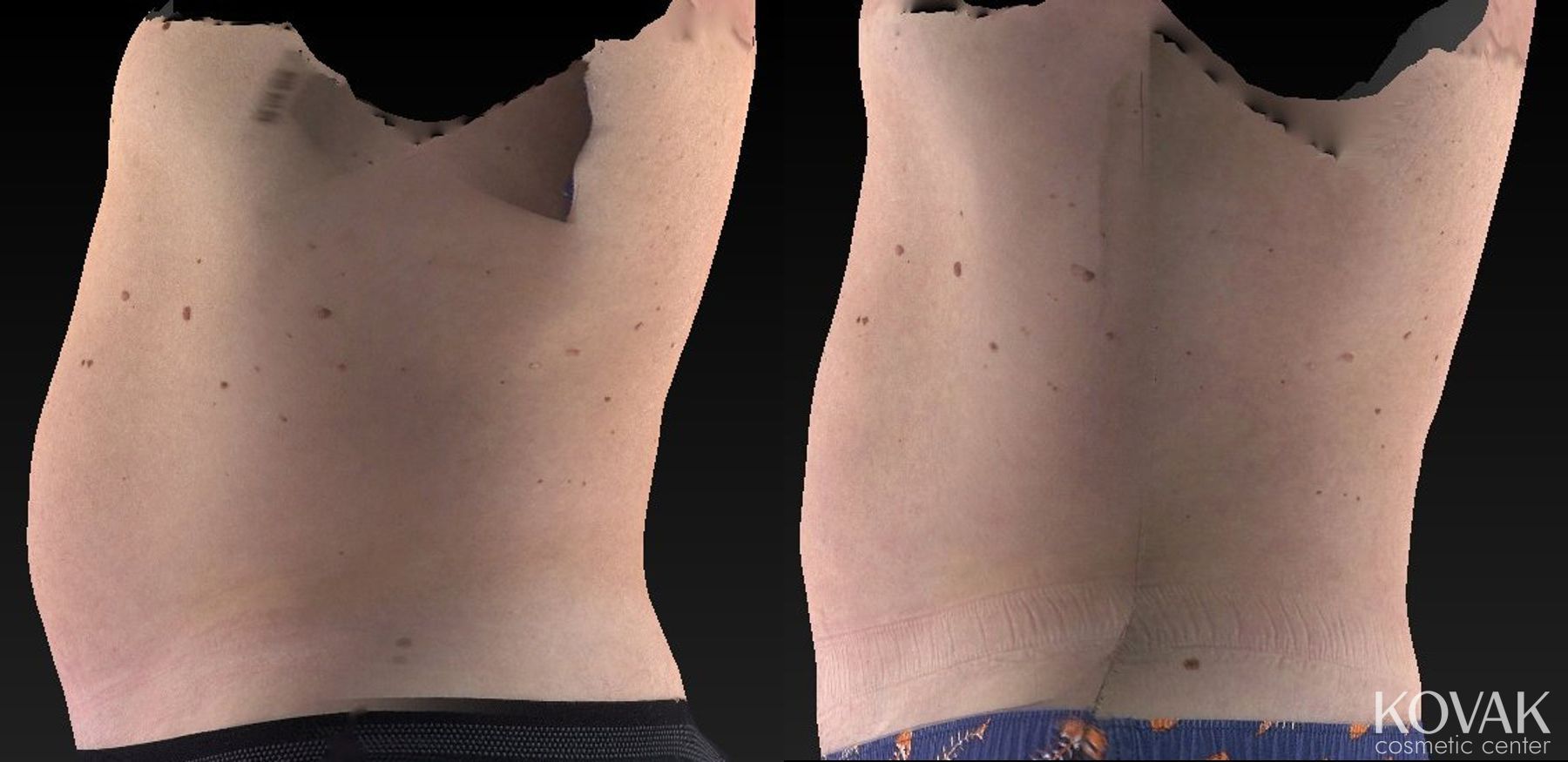 Before and after CoolSculpting® case 36555 - Angle 2