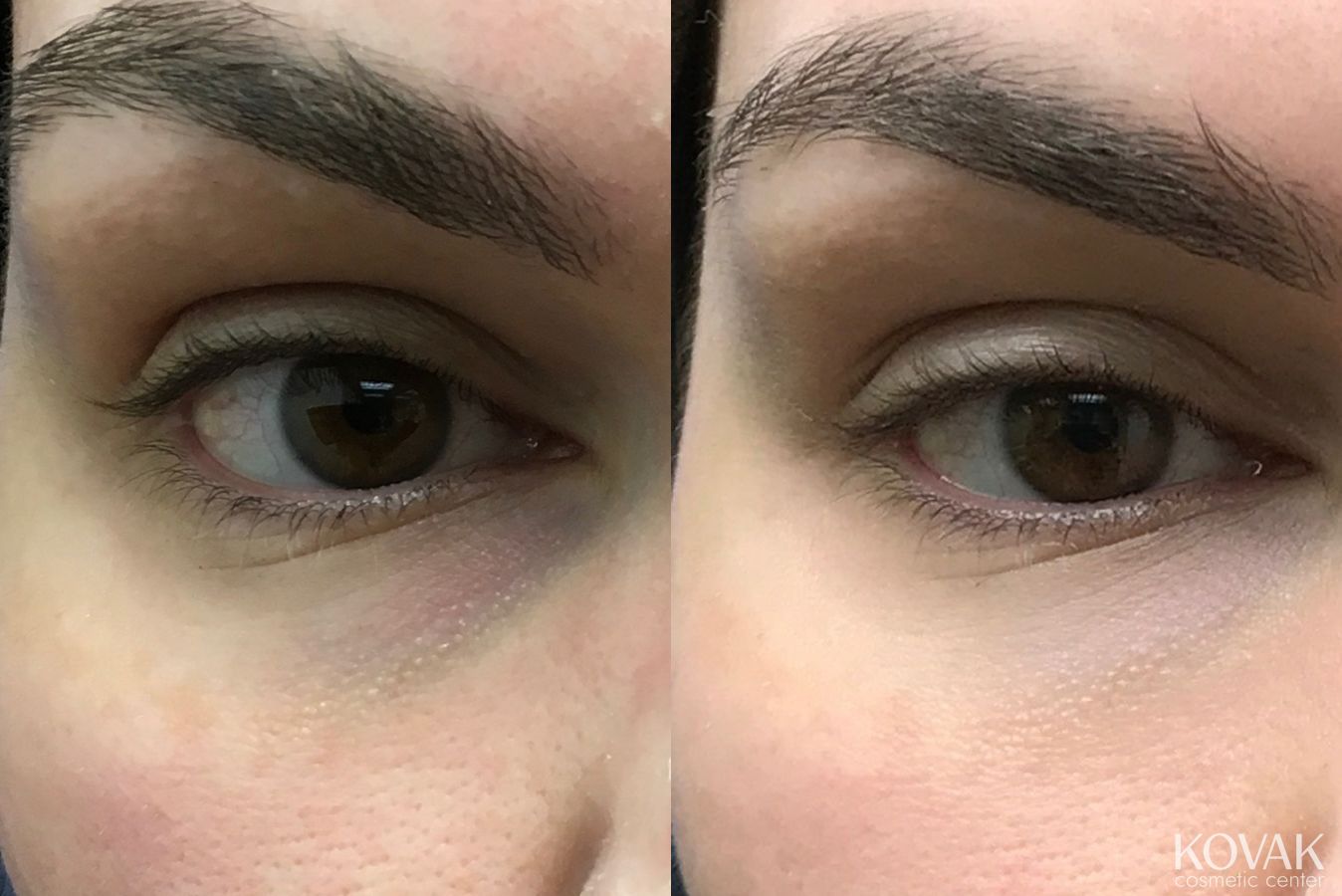 Before and after Eye Treatments case 36680
