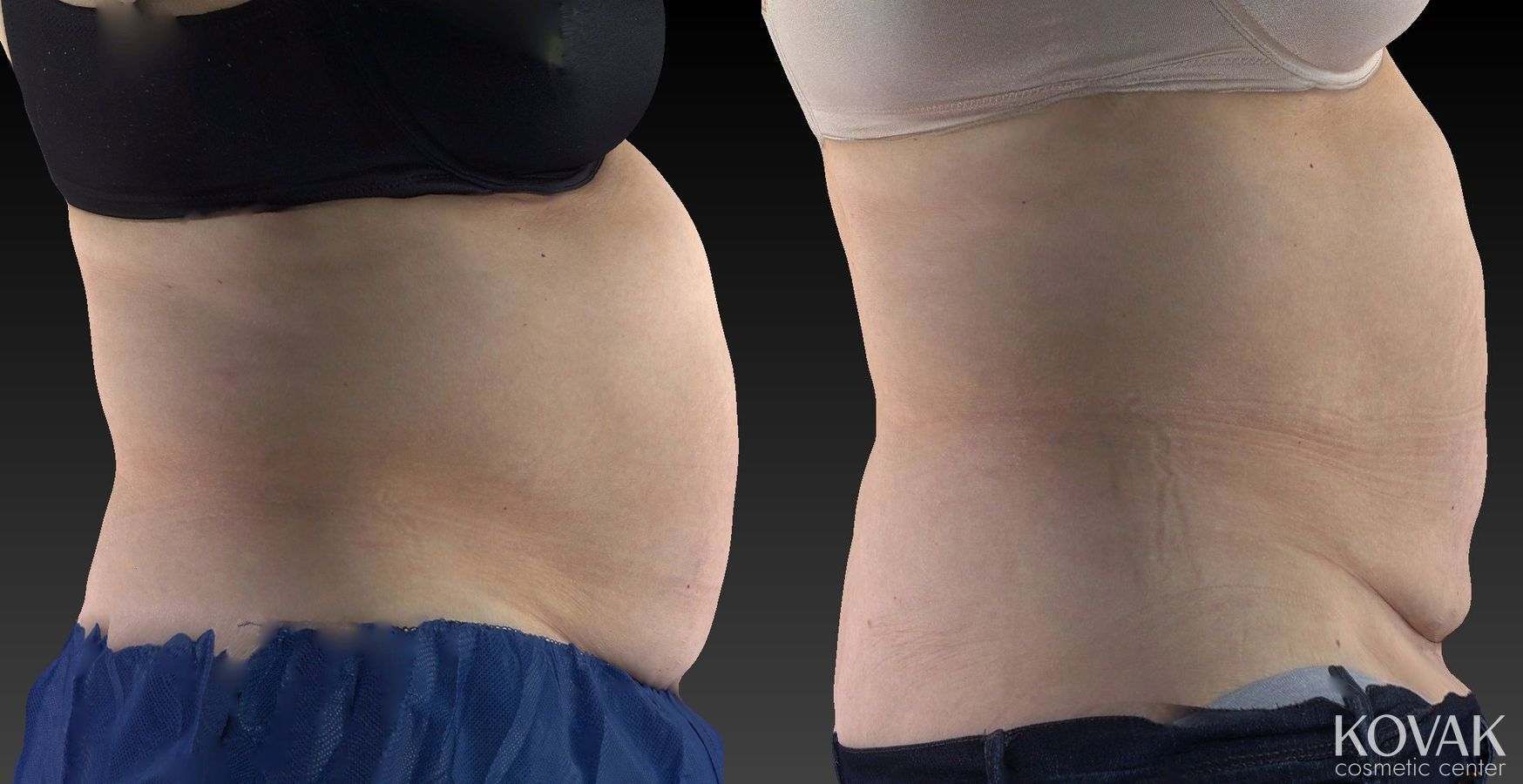 Before and after CoolSculpting® case 36480 - Angle 4