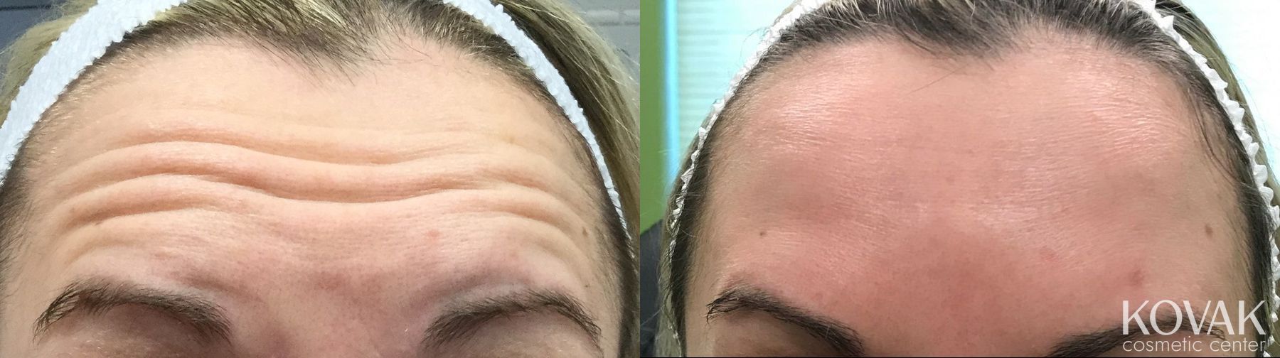 Before and after BOTOX® Cosmetic case 36557