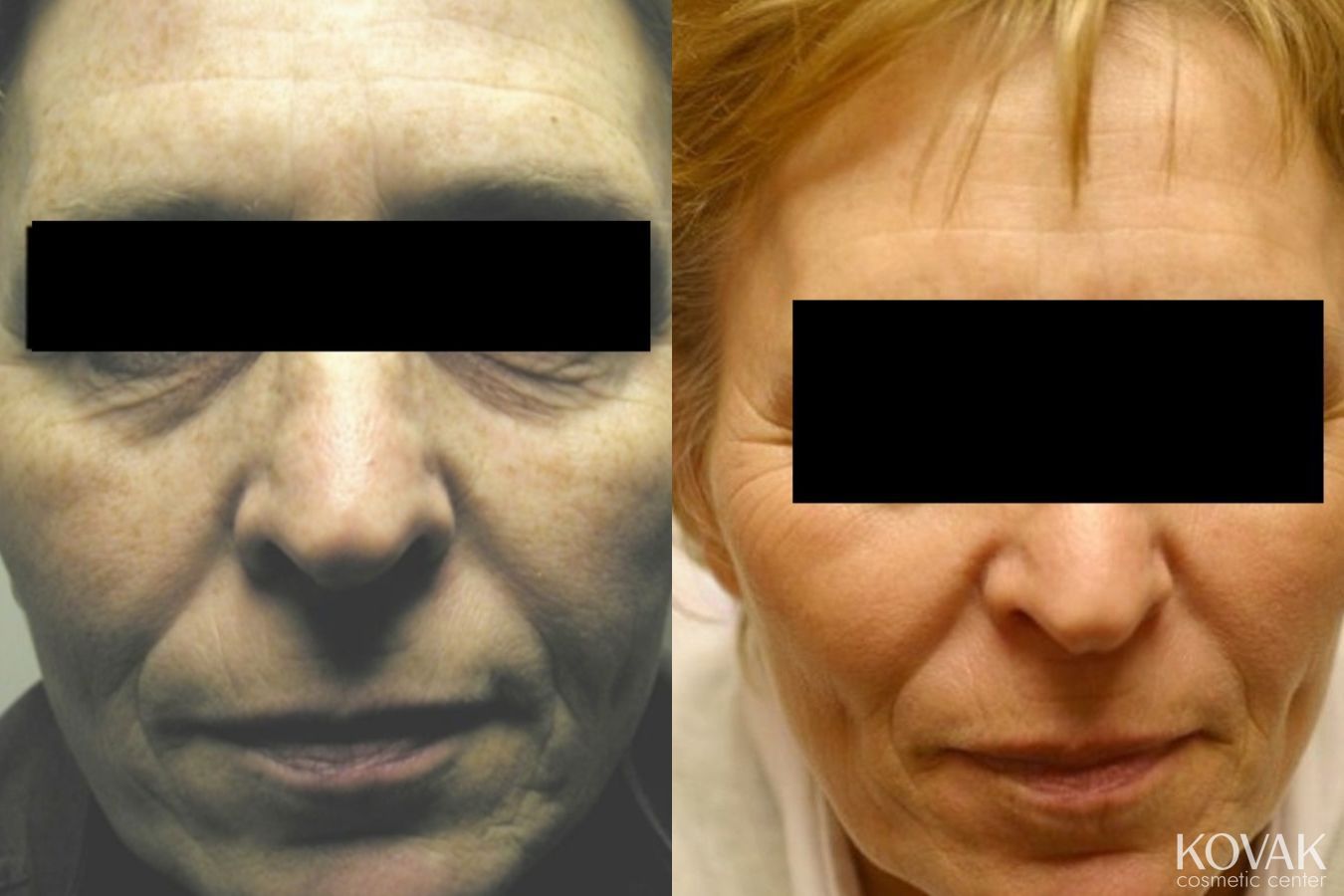 Before and after Tyte and Bryte Photorejuvenation case 36689