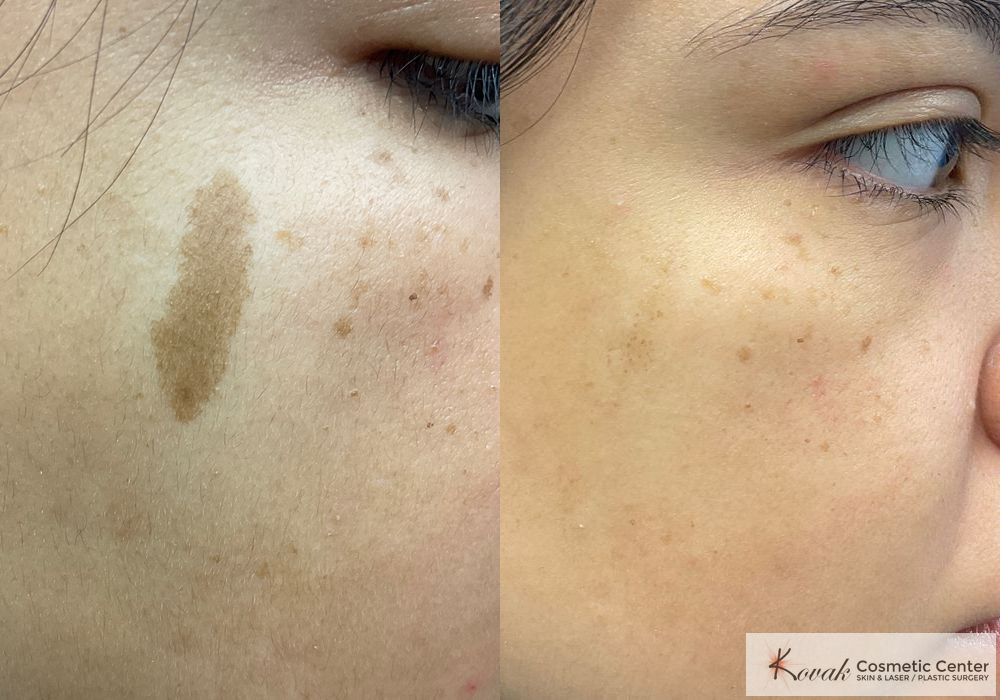 Birthmarks - Case 1571