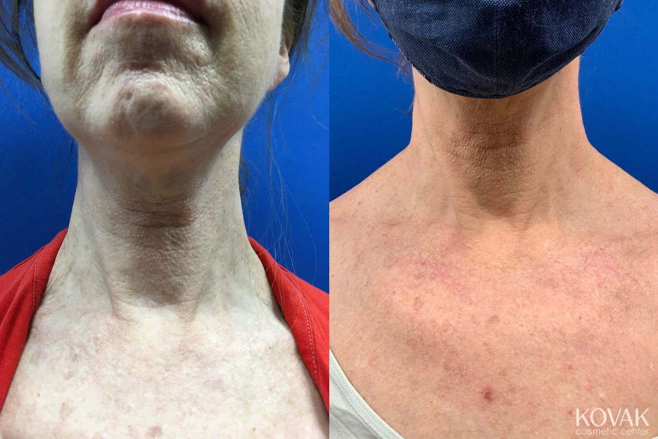 Before and after Microneedling with Scarlet case 36683