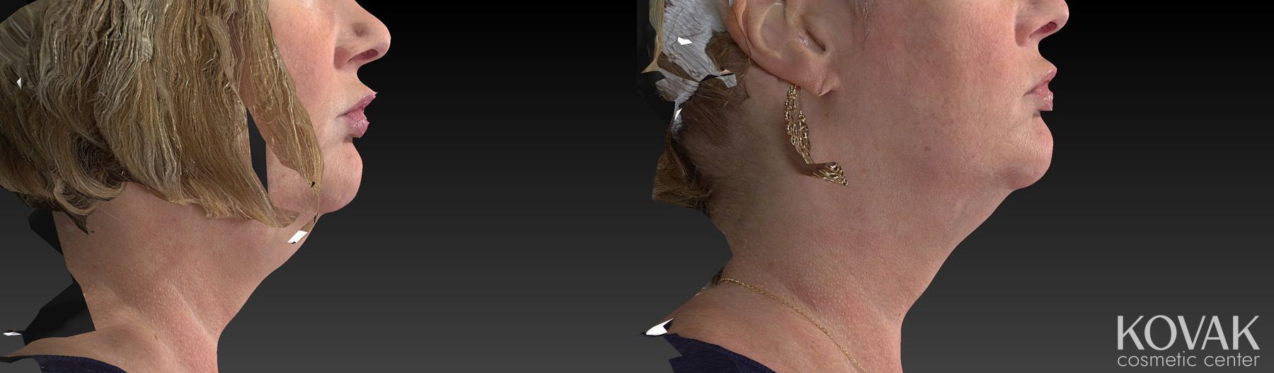 Before and after Kybella case 36478 - Angle 5