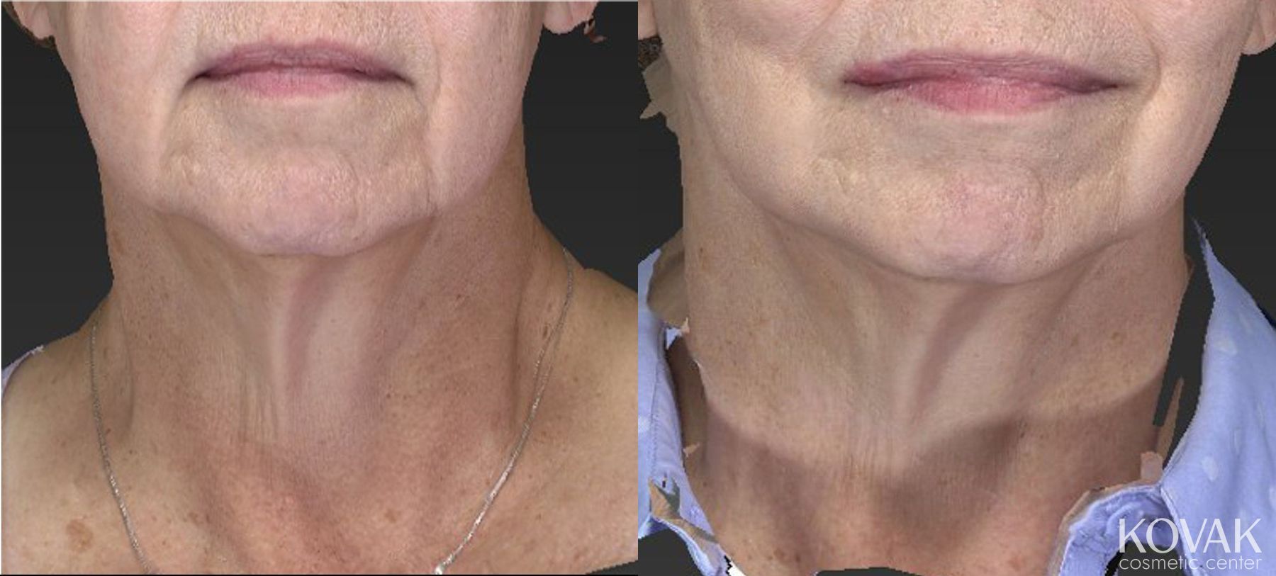 Before and after CoolSculpting® case 36456