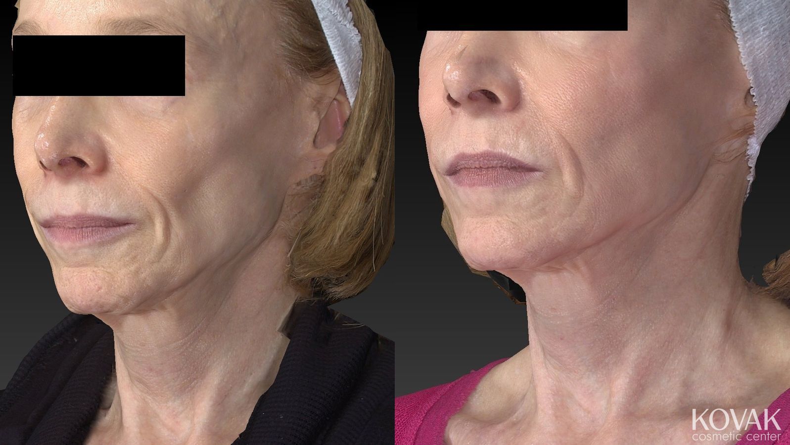Before and after Sculptra® case 36464 - Angle 4