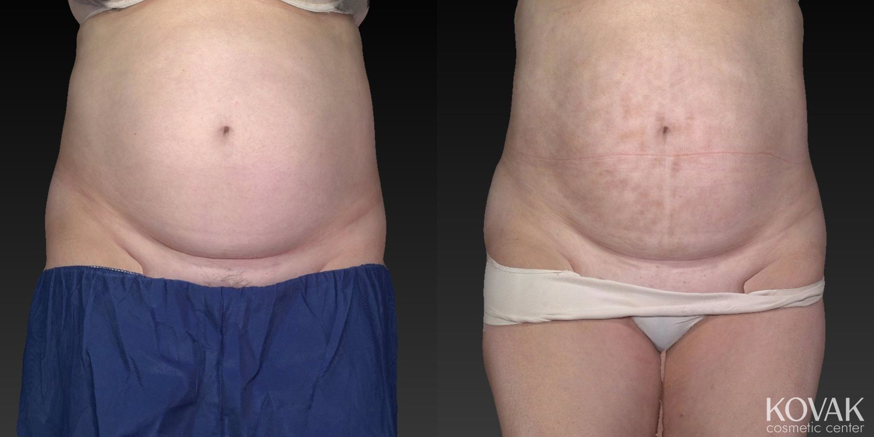 Before and after CoolSculpting® case 36481