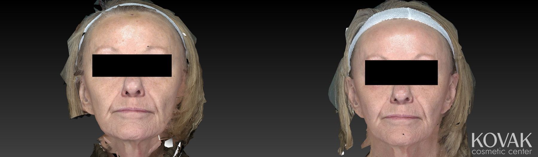 Before and after Halo™ case 36482 - Angle 2