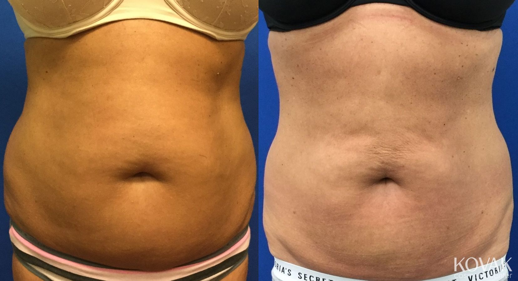 Before and after CoolSculpting® case 36465
